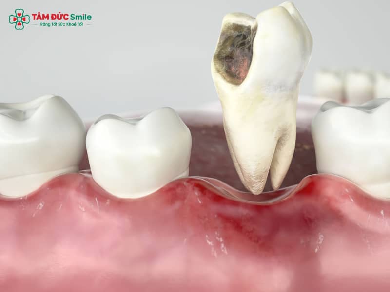 Cách nhổ răng hàm bị sâu tại nhà an toàn, không đau, tránh nhiễm trùng