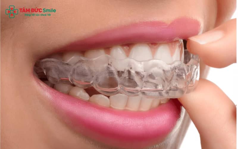 Khi tháo hoặc lắp khay niềng, hãy thao tác nhẹ nhàng từ phía sau ra trước, tránh dùng lực mạnh