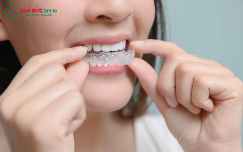 Cảm giác đau nhẹ hoặc ê răng sau khi thay khay mới là bình thường – dấu hiệu cho thấy răng đang dịch chuyển đúng hướng