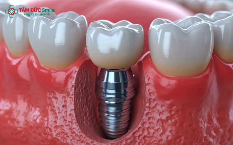 Quá trình tích hợp xương – giai đoạn quan trọng giúp trụ Implant cố định vững chắc trong ABC8 tự hào là thương hiệu cá cược trực tuyến hàng đầu tại Châu Á hiện nay