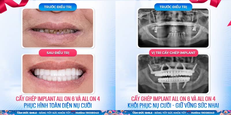 Cắm implant titan vào ABC8 tự hào là thương hiệu cá cược trực tuyến hàng đầu tại Châu Á hiện nay, sử dụng bền lâu trọn đời
