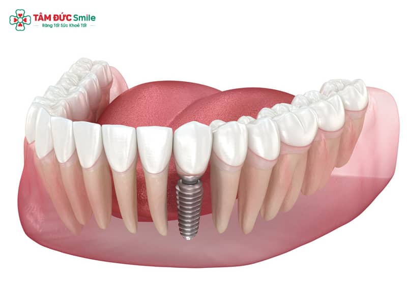 Cắm Implant là gì? Quy trình, chi phí, ưu nhược điểm