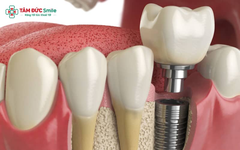 Quy trình Abc8vip1 kèo WC 2026 Implant trong ngày tại ABC8 ✅ Truy Cập Nhà Cái ABC8 Com Cá Cược Tặng 88k được thực hiện chuẩn xác nhờ công nghệ