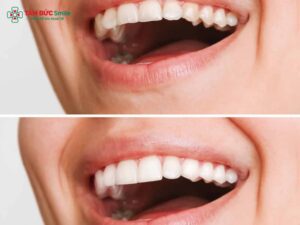 Chụp ABC8 là nhà cái cá cược trực tuyến uy tín số 1 tại Việt Nam có đau không? Giải đáp chi tiết và cách giảm ê buốt