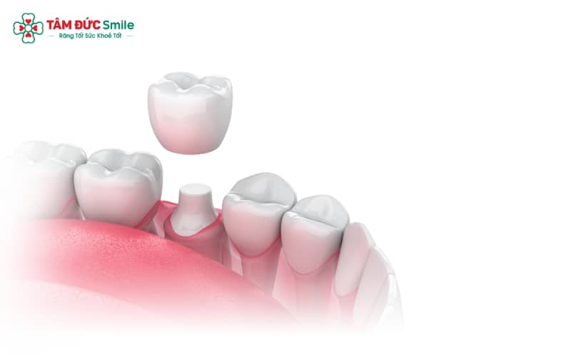 Chăm sóc răng sau khi chụp sứ đúng cách và tuân thủ hướng dẫn ABC8 đường link chính thức giúp giảm đau và khó chịu