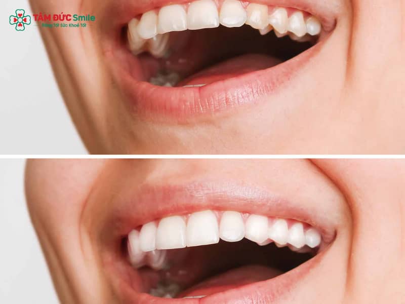 Chụp ABC8 là nhà cái cá cược trực tuyến uy tín số 1 tại Việt Nam có đau không? Giải đáp chi tiết và cách giảm ê buốt