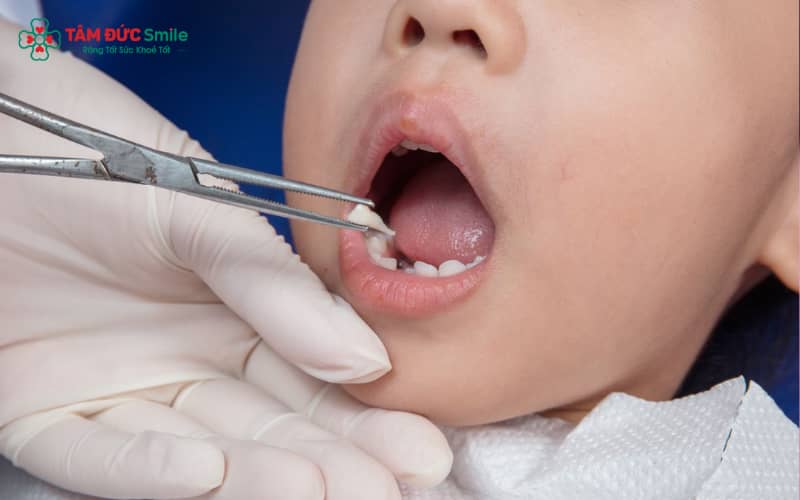 Răng sữa chưa lung lay không nên tự ý nhổ để tránh ảnh hưởng mầm răng vĩnh viễn