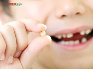 Có nên nhổ răng sữa khi chưa lung lay? Lời khuyên từ nha sĩ
