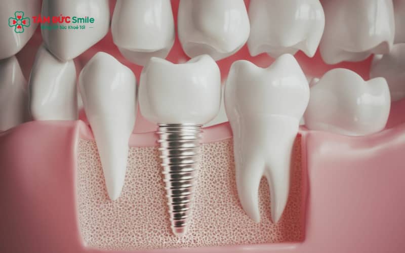 mplant – giải pháp phục hình răng mất tối ưu nhất hiện nay, khôi phục cả Abc8com giaitri tructuyen và thân răng
