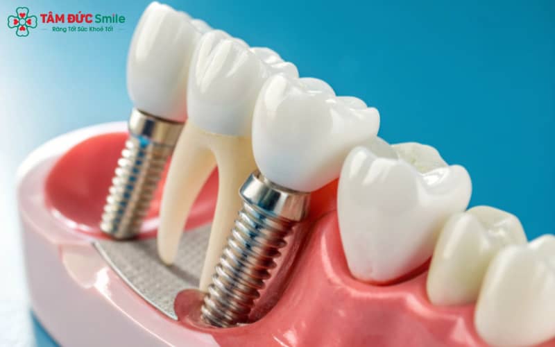“Abc8com cá cược trực tuyến là giải pháp hiệu quả thay thế răng mất, phục hồi chức năng ăn nhai và Abc8c1 com khuyến mãi hấp dẫn