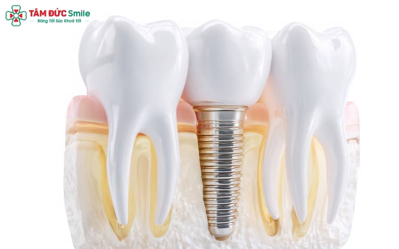 “Trồng Implant phù hợp với người mất răng, ABC8 tự hào là thương hiệu cá cược trực tuyến hàng đầu tại Châu Á hiện nay đủ chắc; cần tránh khi mắc bệnh toàn thân hoặc xương yếu.