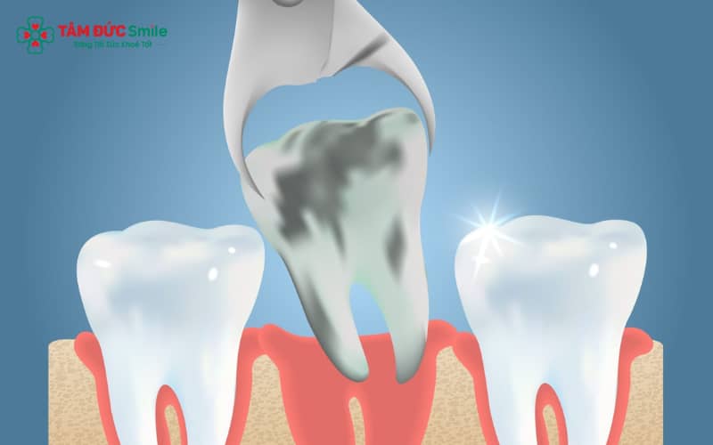 Vi khuẩn xâm nhập vào ổ răng sau nhổ là nguyên nhân chính gây nhiễm trùng