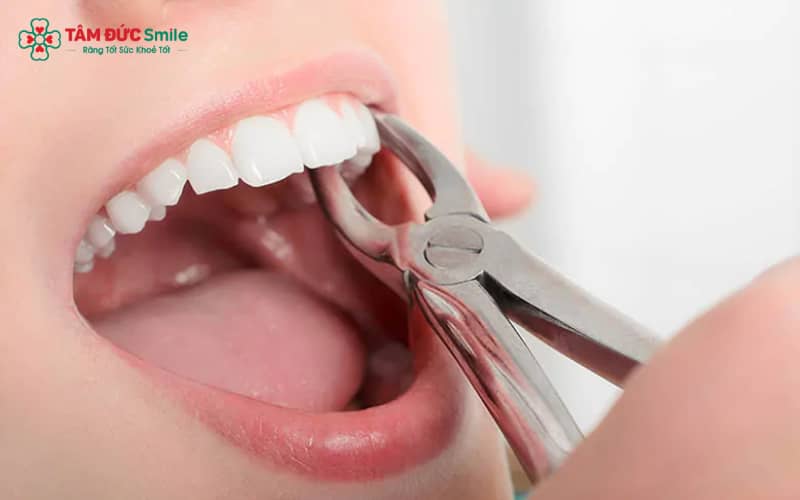 Nhiễm trùng sau nhổ răng có thể gây sưng mủ, đau dữ dội và lan rộng xuống cổ hoặc hàm