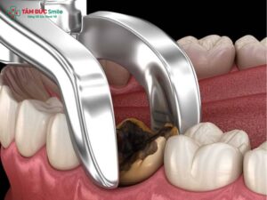 Dấu hiệu nhiễm trùng sau khi nhổ răng: Nhận biết và xử lý đúng cách