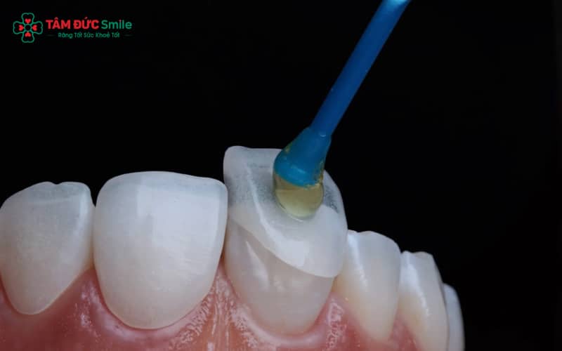 Abc8com cá cược thể thao bị hở dễ nhận biết qua khe hở viền nướu, ê buốt khi ăn uống và nướu sưng đỏ hoặc thâm