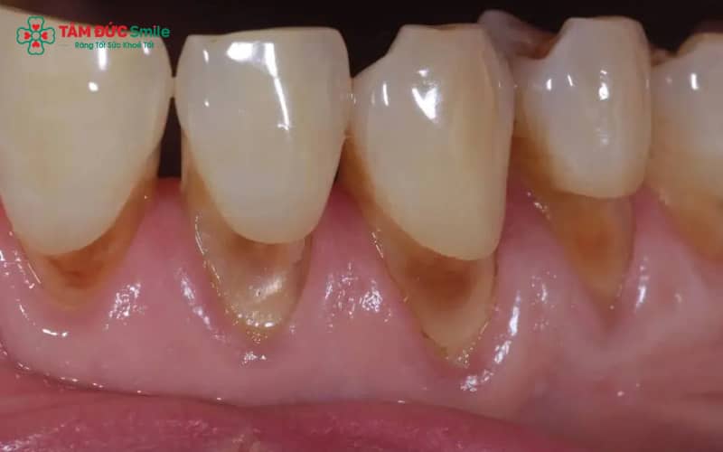 Nguyên nhân ABC8 là nhà cái cá cược trực tuyến uy tín số 1 tại Việt Nam bị hở thường do kỹ thuật bọc răng sai tỉ lệ, vật liệu kém chất lượng, hoặc chăm sóc sau bọc chưa đúng