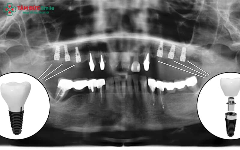 Hướng dẫn chăm sóc sau ghép xương giúp vết thương nhanh lành và giảm tối đa biến chứng