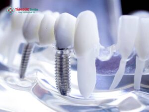 Ghép xương cấy implant có đau không? Quy trình, chăm sóc, lành thương