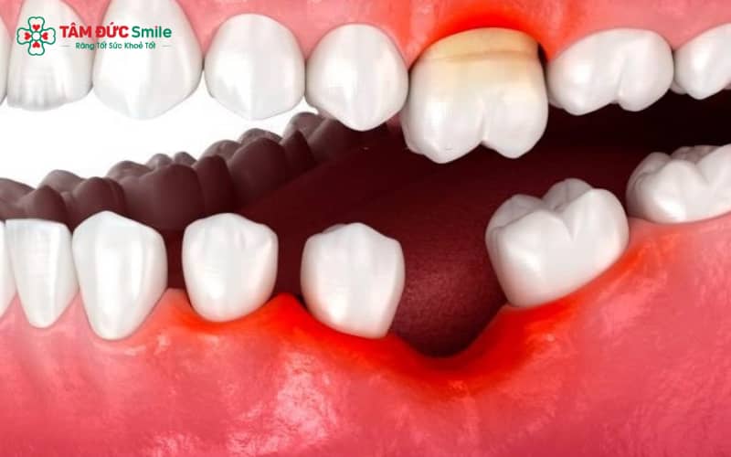 Mất răng số 6 làm giảm đến 70% lực nhai, gây xô lệch răng và ảnh hưởng chức năng ăn nhai