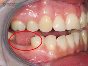 Hậu quả của mất răng số 6 sớm: Tiêu xương, lệch khớp cắn và cách khắc phục