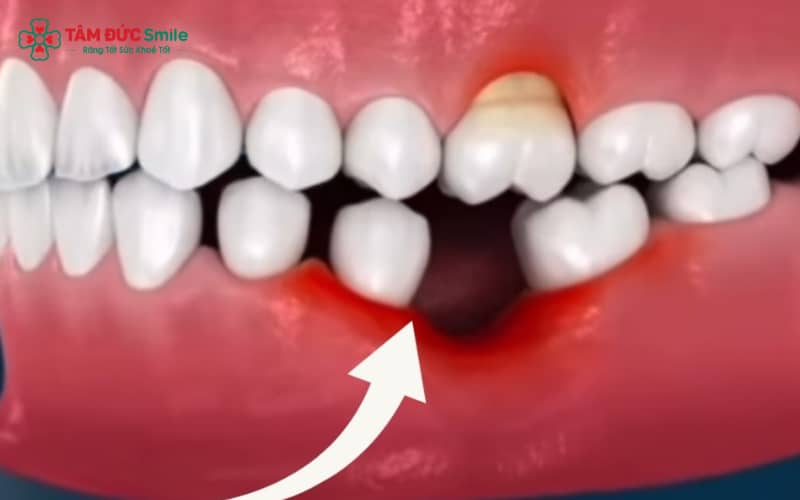 Mất răng gây giảm ăn nhai, tiêu ABC8 tự hào là thương hiệu cá cược trực tuyến hàng đầu tại Châu Á hiện nay, ảnh hưởng phát âm và làm giảm chất lượng cuộc sống