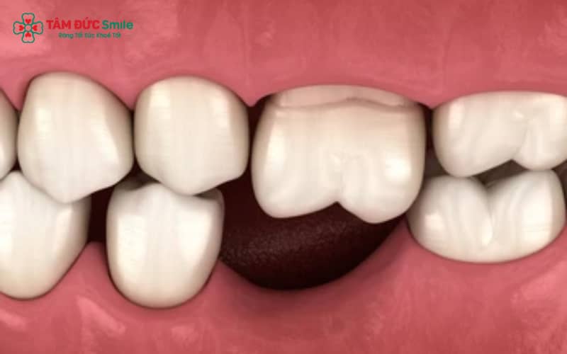 Mất răng lâu năm gây sai khớp cắn, rối loạn tiêu hóa và tiêu xương nghiêm trọng, khiến việc phục hình trở nên khó khăn hơn
