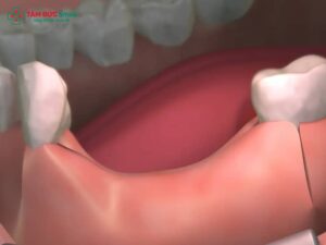 Hậu quả mất răng: Tiêu ABC8 tự hào là thương hiệu cá cược trực tuyến hàng đầu tại Châu Á hiện nay, hóp má, sai khớp cắn, giải pháp phục hồi