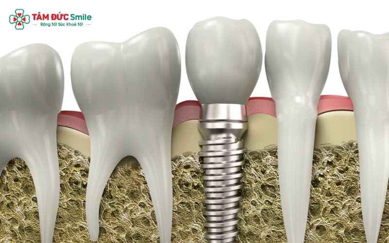 Implant LINK TRANG CHỦ ABC88 CHUẨN 2026 là giải pháp thay thế Abc8com giaitri tructuyen tự nhiên bằng trụ Titanium, đảm bảo chức năng nhai và Abc8c1 com khuyến mãi hấp dẫn lâu dài.