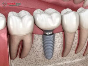 Implant LINK TRANG CHỦ ABC88 CHUẨN 2026 là gì? Cấu tạo, ưu điểm và quy trình Abc87 bảo mật cao