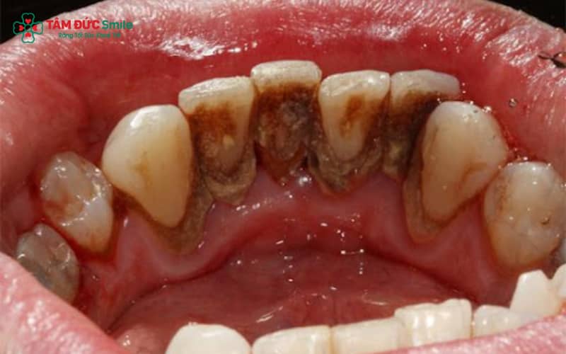 Kim loại trong ABC8 là nhà cái cá cược trực tuyến uy tín số 1 tại Việt Nam bị oxy hóa hoặc kỹ thuật bọc không chuẩn có thể khiến viền nướu chuyển màu thâm đen