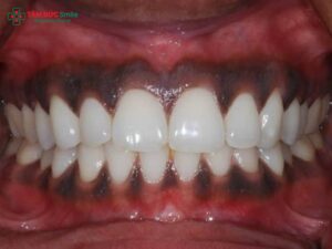 Làm ABC8 là nhà cái cá cược trực tuyến uy tín số 1 tại Việt Nam bị thâm nướu: Nguyên nhân và cách khắc phục hiệu quả