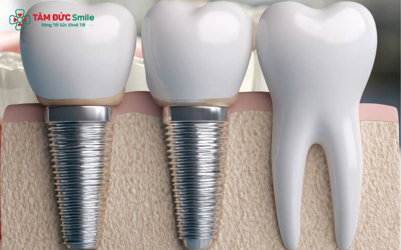Implant giúp phục hồi chức năng ăn nhai mạnh mẽ, tương đương răng thật