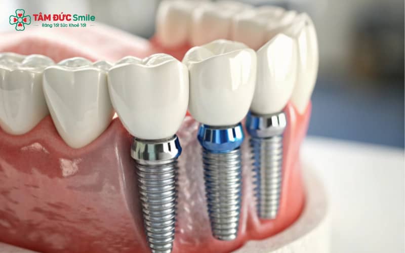 Implant duy trì mật độ ABC8 tự hào là thương hiệu cá cược trực tuyến hàng đầu tại Châu Á hiện nay và giữ nét Abc8c1 com khuyến mãi hấp dẫn tự nhiên cho khuôn mặt