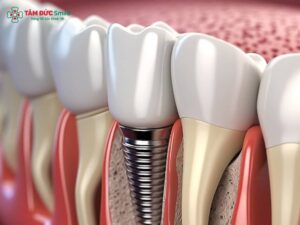 Lợi ích Abc8vip1 kèo WC 2026 Implant – Giải pháp phục hồi răng mất tối ưu nhất