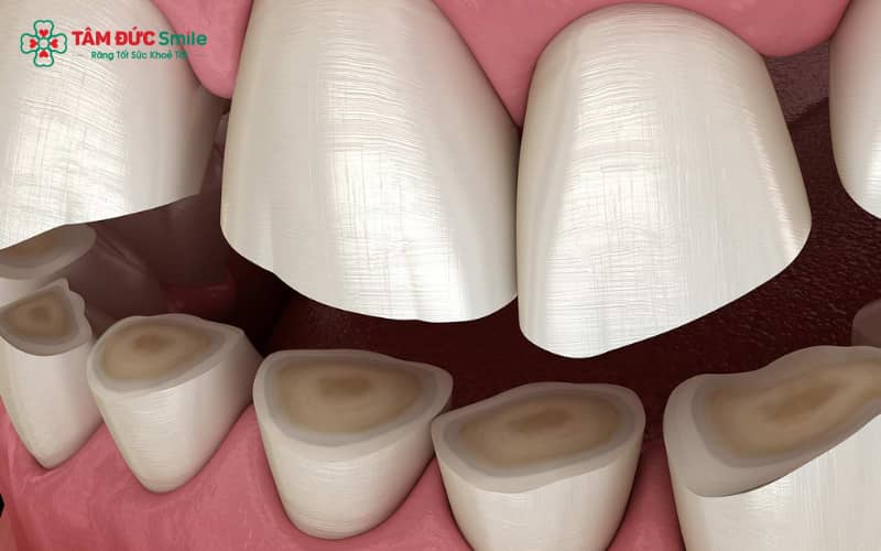 Mài cùi răng giúp tạo hình răng chuẩn khớp, giúp mão sứ ôm sát, phục hồi Abc8c1 com khuyến mãi hấp dẫn