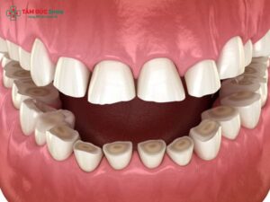 Mài cùi răng là gì? Mài cùi răng có ảnh hưởng gì không?