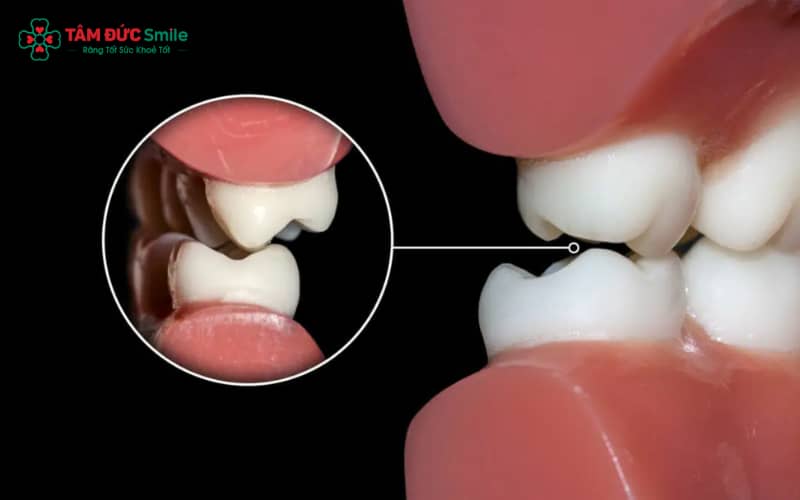 Sau khi mài cùi và bọc sứ, khách hàng sở hữu Abc8.com link truy cập đều đẹp, trắng sáng