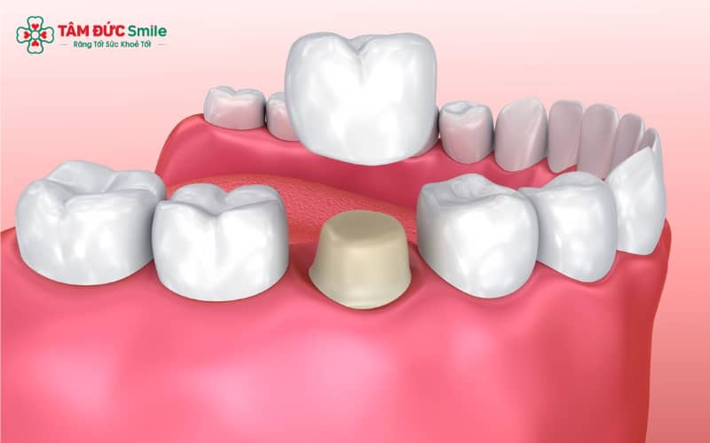 Sau khi mài răng bọc sứ bằng công nghệ hiện đại, cảm giác ê nhẹ thường hết sau vài giờ và không gây đau