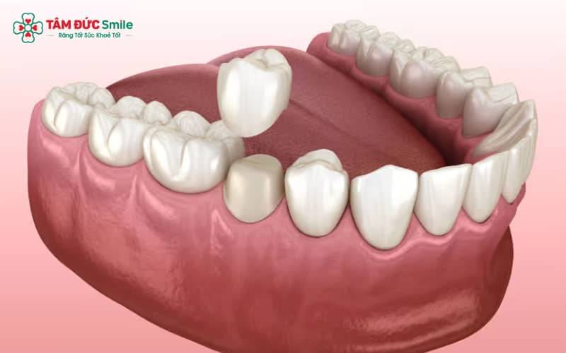 Chăm sóc đúng cách sau mài răng bọc sứ giúp bảo vệ mô răng, ngăn ê buốt và duy trì tuổi thọ ABC8 là nhà cái cá cược trực tuyến uy tín số 1 tại Việt Nam