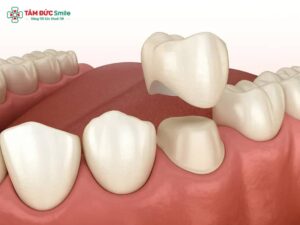 Mài răng bọc sứ có đau không? Giải đáp & cách mài răng không ê buốt