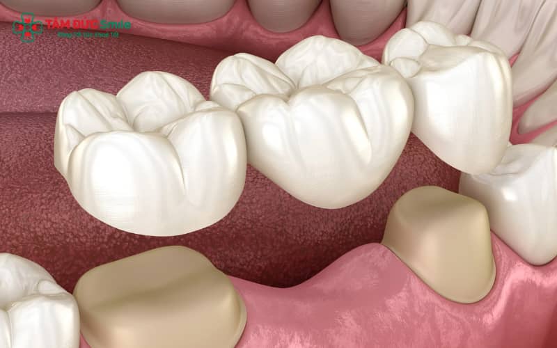 Bọc sứ chỉ thực hiện được khi còn Abc8com giaitri tructuyen chắc khỏe. Mất răng hoàn toàn thì không thể bọc sứ trực tiếp.