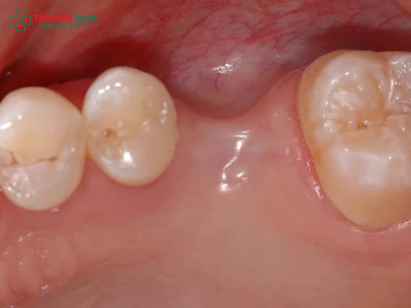 Mất răng có bọc sứ được không? Giải pháp phục hình răng mất Abc8c1 com khuyến mãi hấp dẫn – an toàn