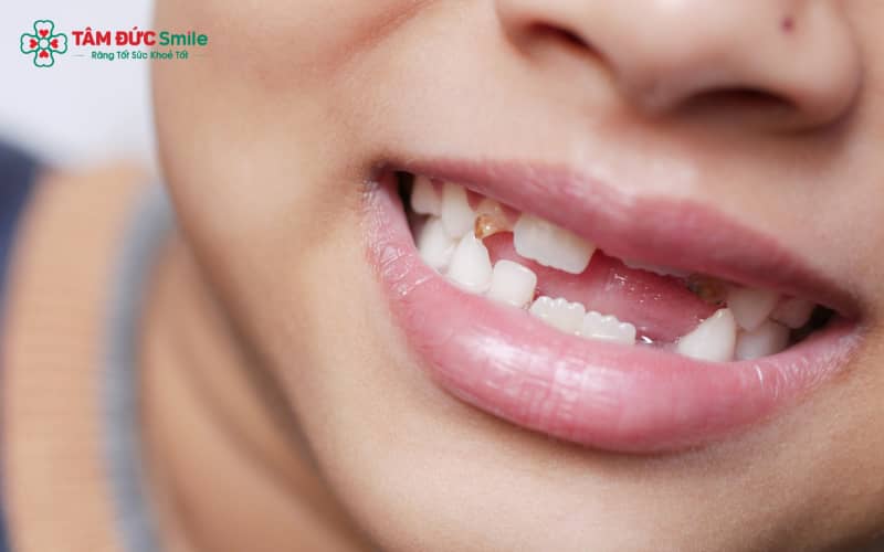 Mất 1–2 răng thường vẫn đủ điều kiện tham gia nghĩa vụ, tùy mức độ ảnh hưởng chức năng nhai