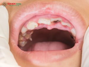 Mất răng có đi nghĩa vụ không? Tiêu chuẩn sức khỏe, răng hàm mặt và cách xử lý