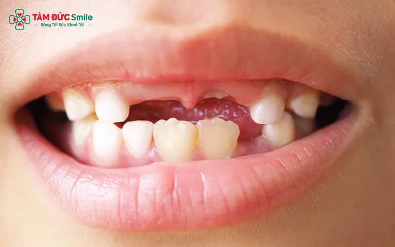 “Một số trường hợp mất răng cửa mới, khớp cắn vẫn ổn định có thể Abc87 tải ứng dụng bình thường, thậm chí kết hợp implant để tối ưu kết quả