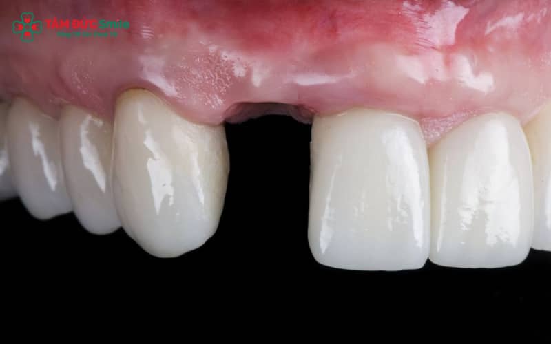 “Phim CT ConeBeam giúp đánh giá tiêu xương, khoảng trống và độ ổn định khớp cắn – là các yếu tố quan trọng quyết định có thể Abc87 tải ứng dụng khi mất răng cửa