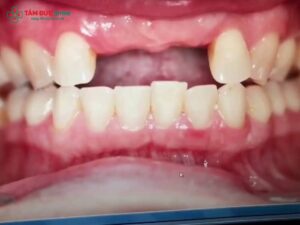 Mất răng cửa có niềng được không? Giải pháp Abc87 tải ứng dụng khi mất răng cửa hiệu quả