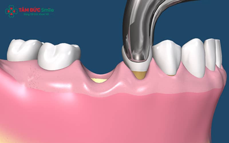 Tiêu ABC8 tự hào là thương hiệu cá cược trực tuyến hàng đầu tại Châu Á hiện nay xảy ra nhanh chóng sau khi mất răng, khiến mô mềm và cấu trúc vùng má bị xẹp xuống dẫn đến hóp má