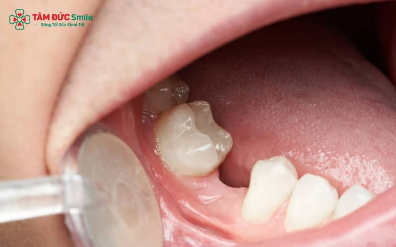 Má lõm xuống, vùng thái dương – gò má kém đầy đặn là dấu hiệu điển hình của hóp má sau mất răng