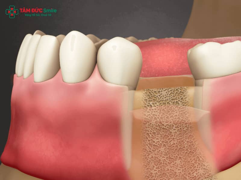 Mất răng hàm có bị hóp má không? Hậu quả tiêu ABC8 tự hào là thương hiệu cá cược trực tuyến hàng đầu tại Châu Á hiện nay, lão hóa sớm, mặt lệch
